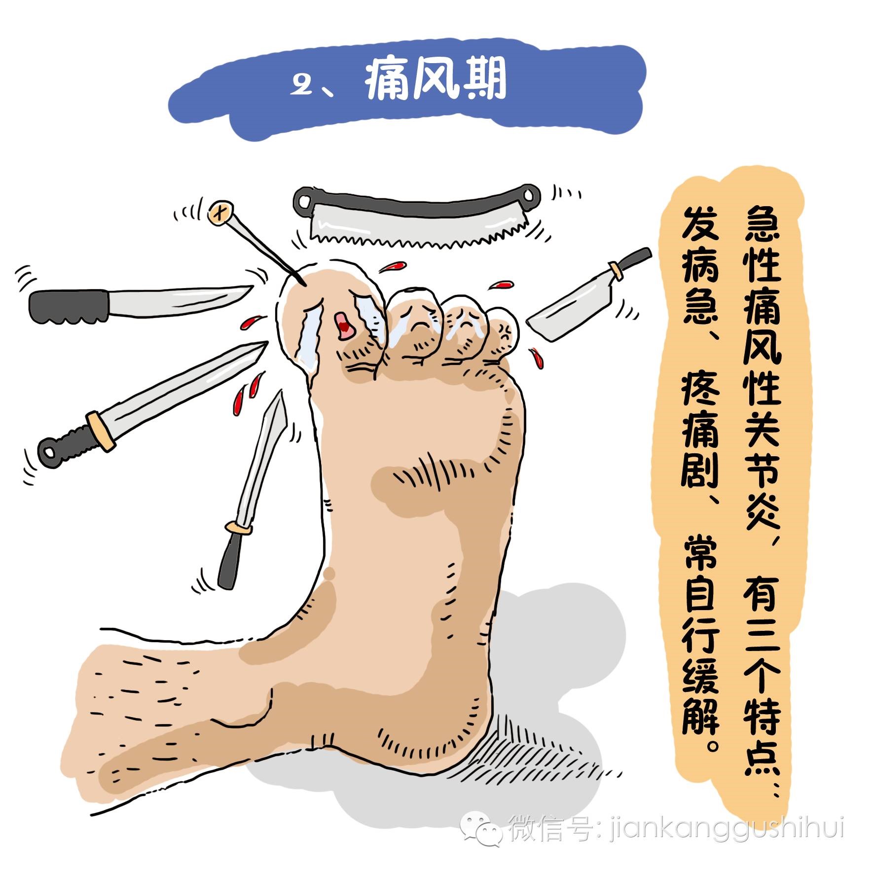 你真的知道什么叫痛风?
